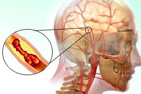 Thrombolysis: indications and complications