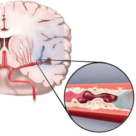 Thrombolysis: indications and complications