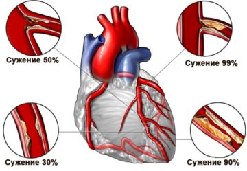 Thrombolysis: indications and complications