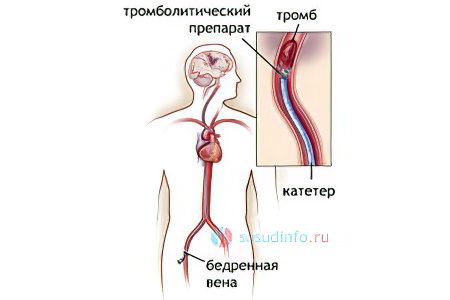 Thrombolysis: indications and complications