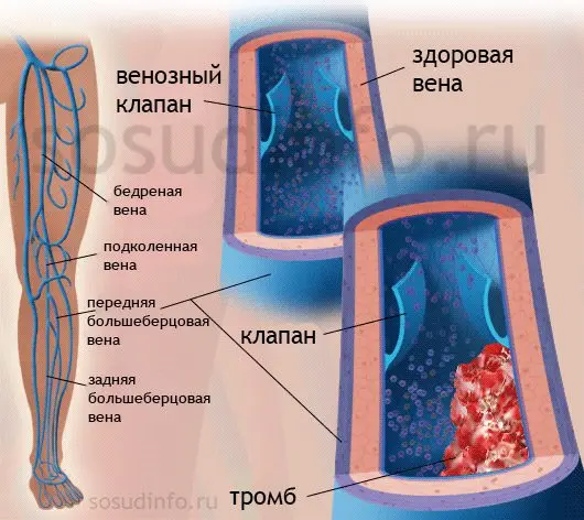 Thrombophlebitis of deep veins of the lower extremities