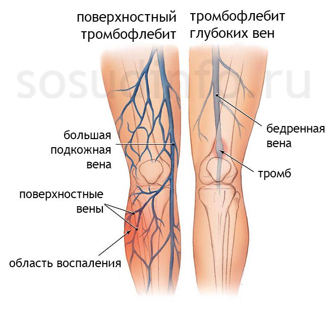 Thrombophlebitis of deep veins of the lower extremities