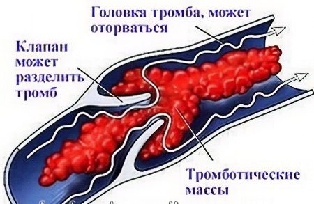 Thrombophlebitis of deep veins of the lower extremities