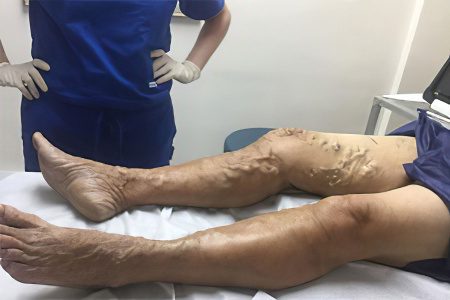 Thrombophlebitis of deep veins of the lower extremities