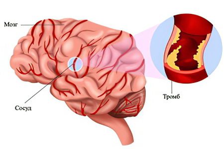 Thrombosis of cerebral vessels