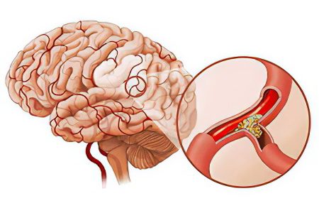 Thrombosis of cerebral vessels