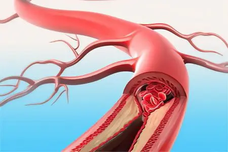 Thrombosis of mesenteric vessels