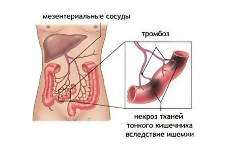 Thrombosis of mesenteric vessels