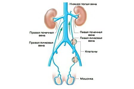 Thrombosis of the inferior vena cava