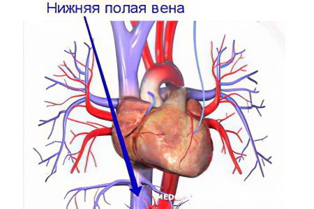 Thrombosis of the inferior vena cava