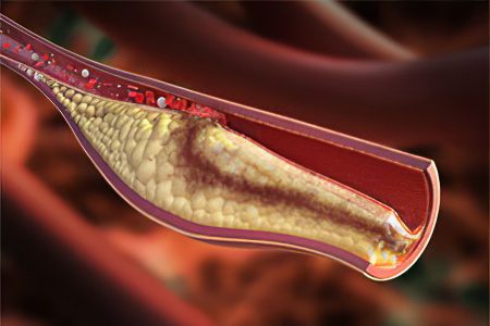 Thrombosis of the internal jugular vein