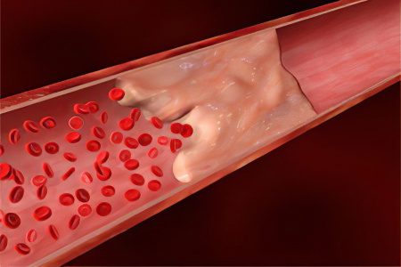 Thrombosis of the mesenteric artery