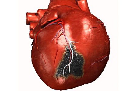 Thrombosis of the mesenteric artery