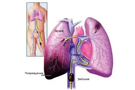 Thrombosis of the pulmonary vein