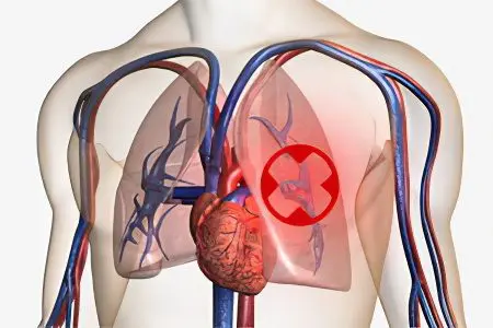 Thrombosis of the pulmonary vein