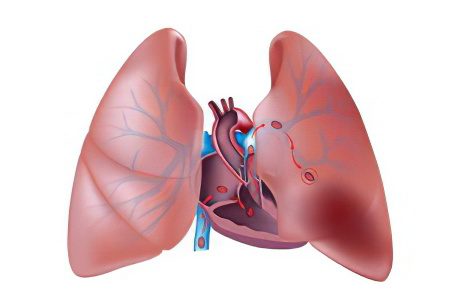 Thrombosis of the pulmonary vein