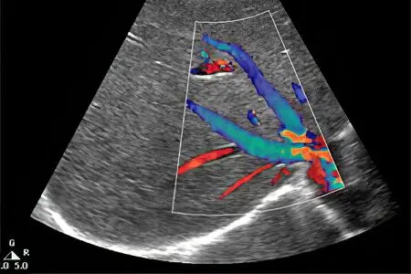 thrombosis of the renal veins