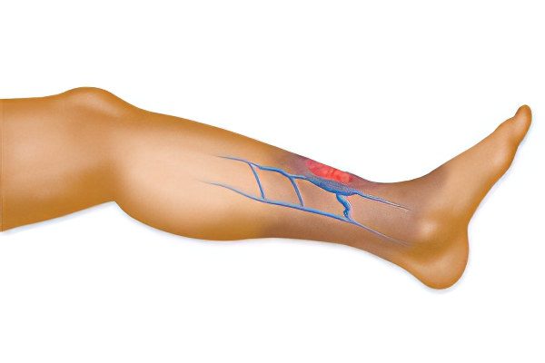 Thrombosis of the sural vein