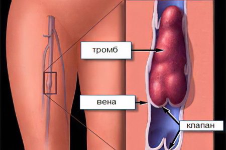 Thrombus in the leg