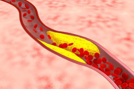 Thunderstorm of blood clots - nattokinase