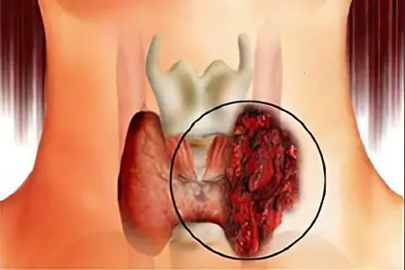 Thyroid adenoma