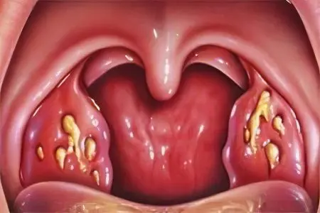 Tonsillitis: causes, symptoms and treatment