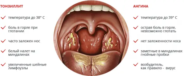 Tonsillitis: causes, symptoms and treatment