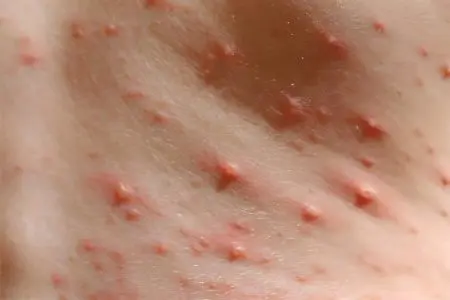 Toxocariasis in children