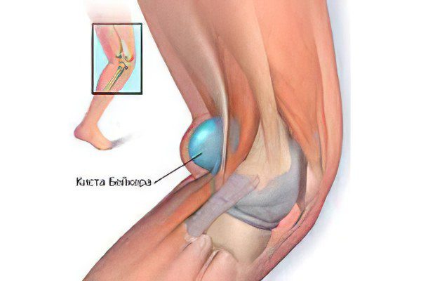 Treatment and operation of a Baker&#8217;s cyst of the knee joint