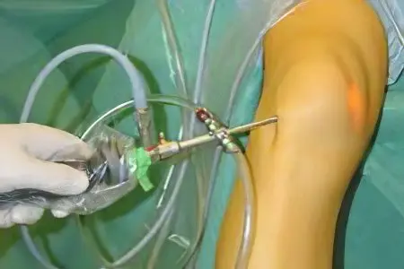 Treatment and operation of a Bakers cyst of the knee joint