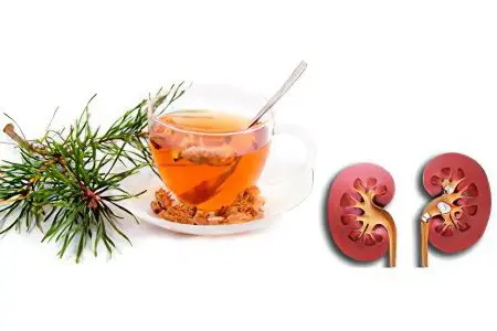 Treatment of kidney stones folk remedies