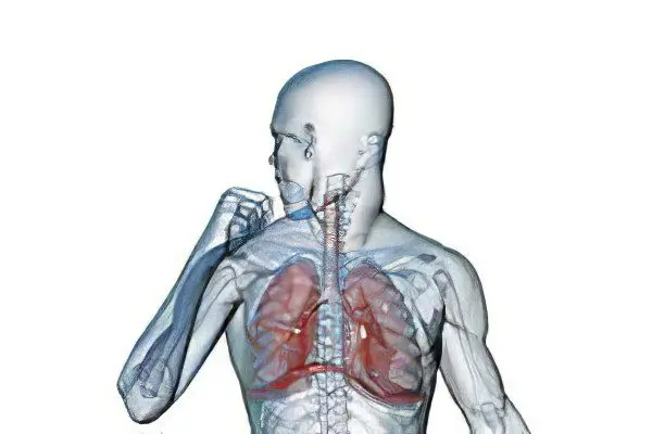 Treatment of severe cough with sputum without fever