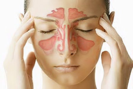 Treatment of sinusitis without a puncture