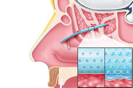 Treatment of sinusitis without a puncture