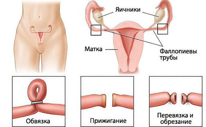 Tubal ligation