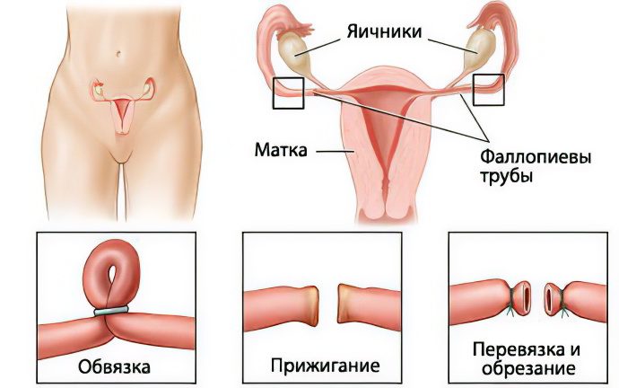 Tubal ligation