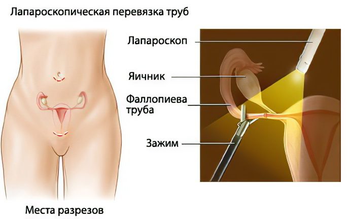 Tubal ligation