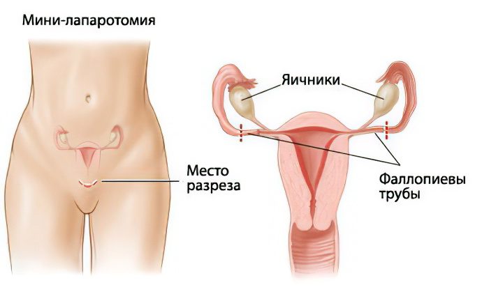 Tubal ligation