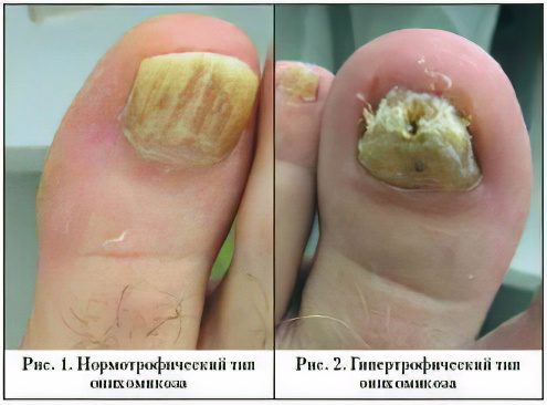 Types and causes of onychomycosis