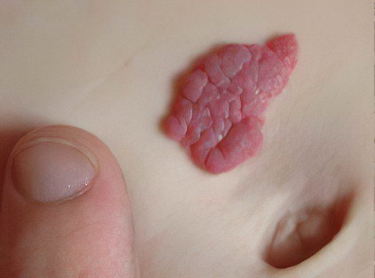 Types and symptoms of hemangioma