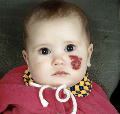 Types and symptoms of hemangioma