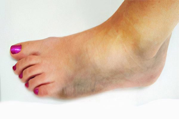 Types, causes and symptoms of gangrene