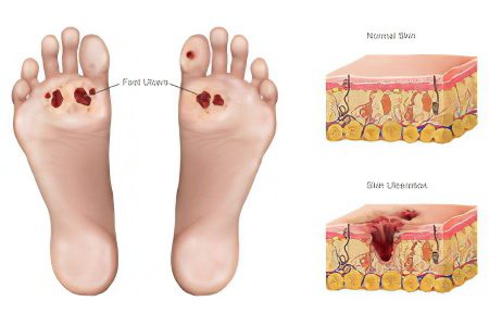 Types, causes and symptoms of gangrene