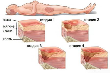 Types, causes and symptoms of gangrene