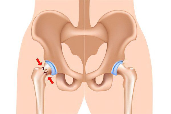 Types, consequences, first aid and treatment of a hip fracture