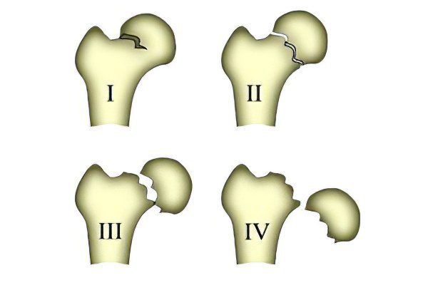 Types, consequences, first aid and treatment of a hip fracture