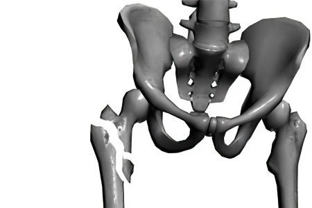 Types, consequences, first aid and treatment of a hip fracture