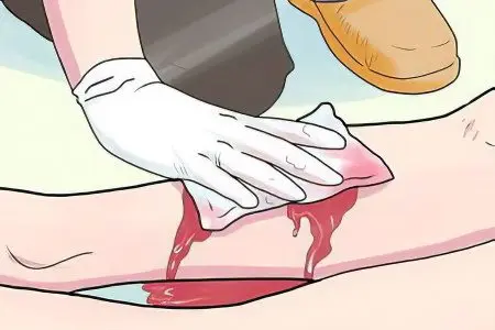 Types of bleeding and first aid