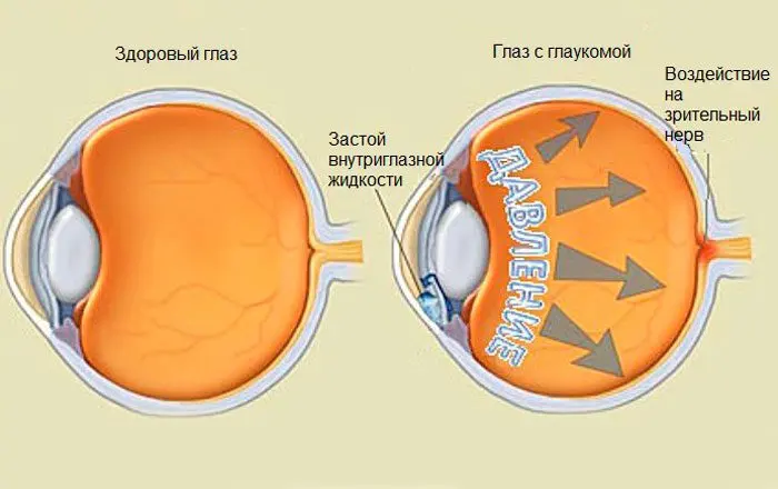 Types of glaucoma, symptoms, causes and treatment