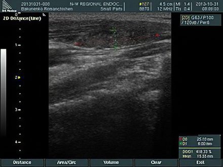 Ultrasound of the thyroid gland &#8211; preparation, what shows what is the norm?